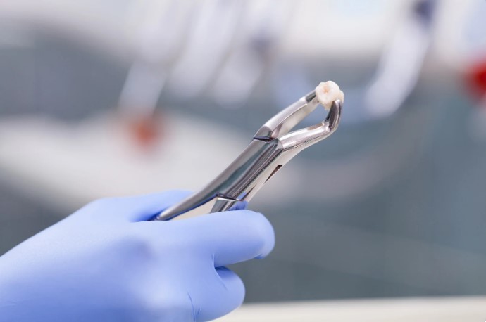 видалення зуба мудрості на нижній щелепі